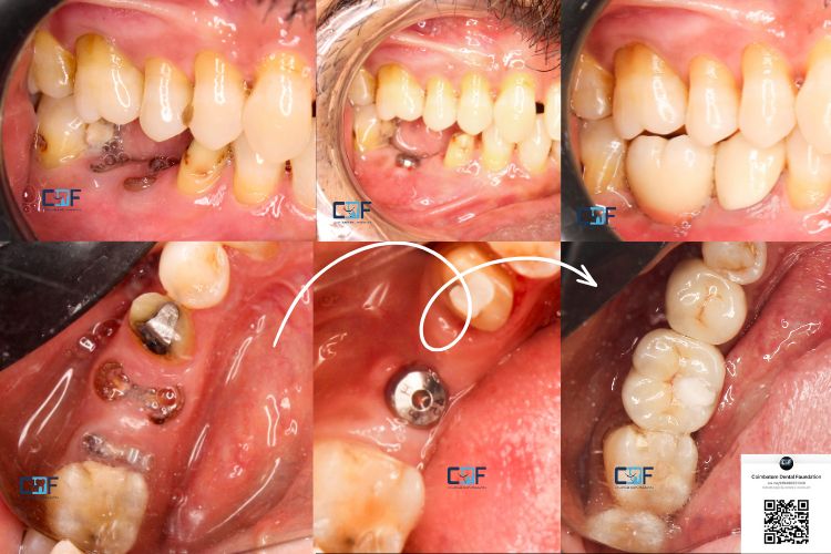 Single Implant Before and After